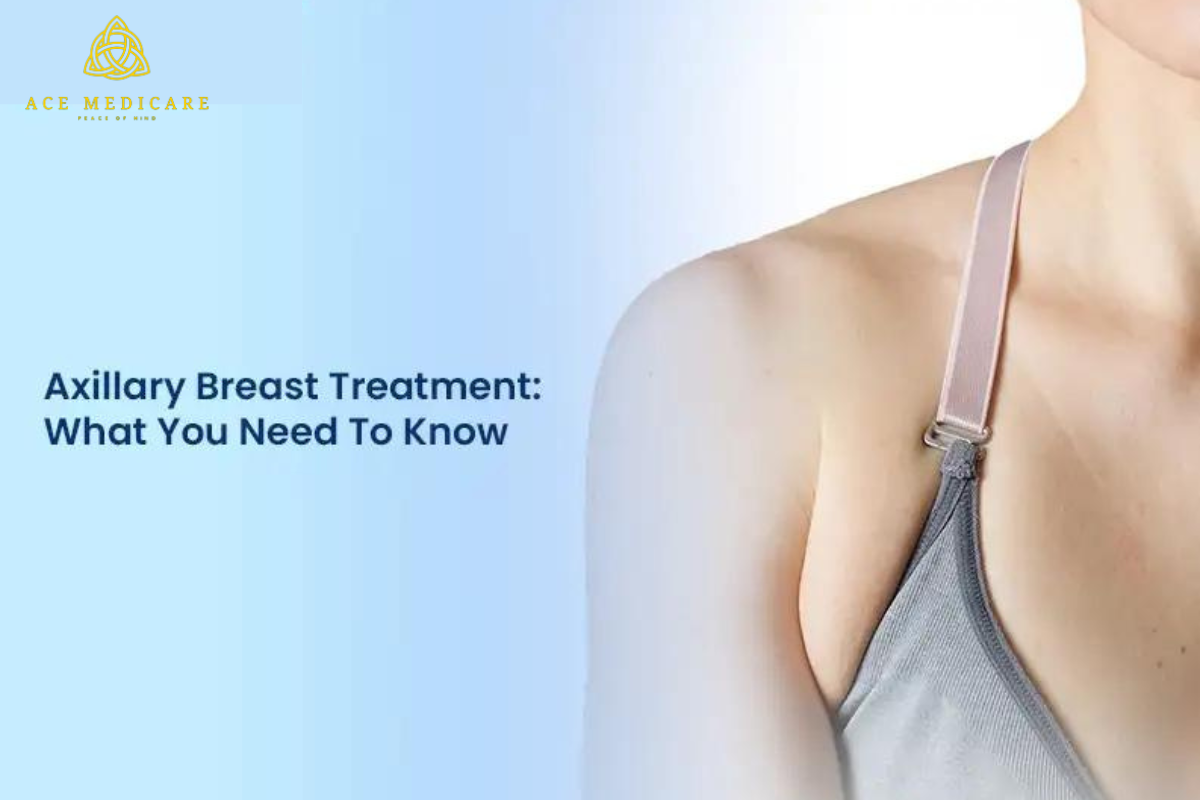 Axillary Breast Tissue: What You Need to Know